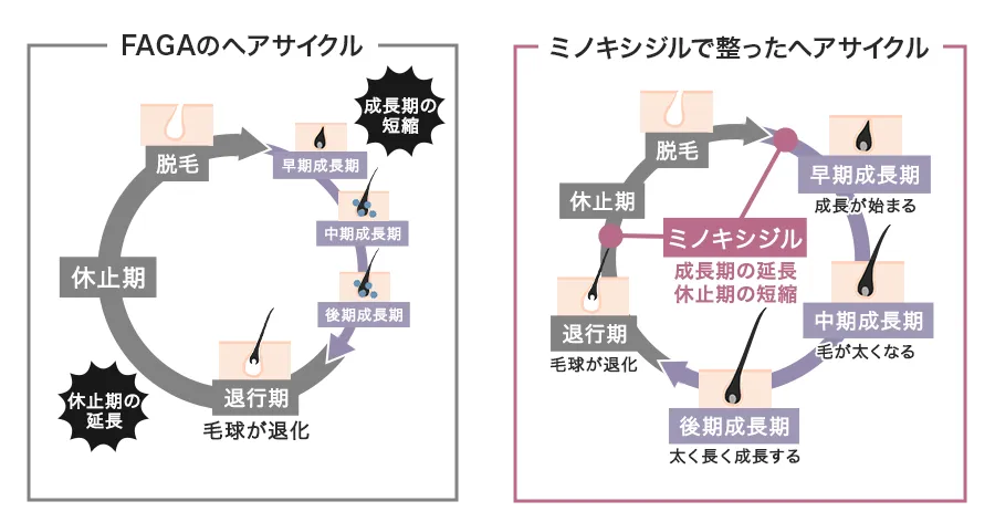 ミノキシジル2%外用薬の実力