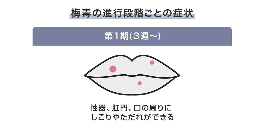 第1期梅毒の症状(初期症状と見逃されやすいポイント)