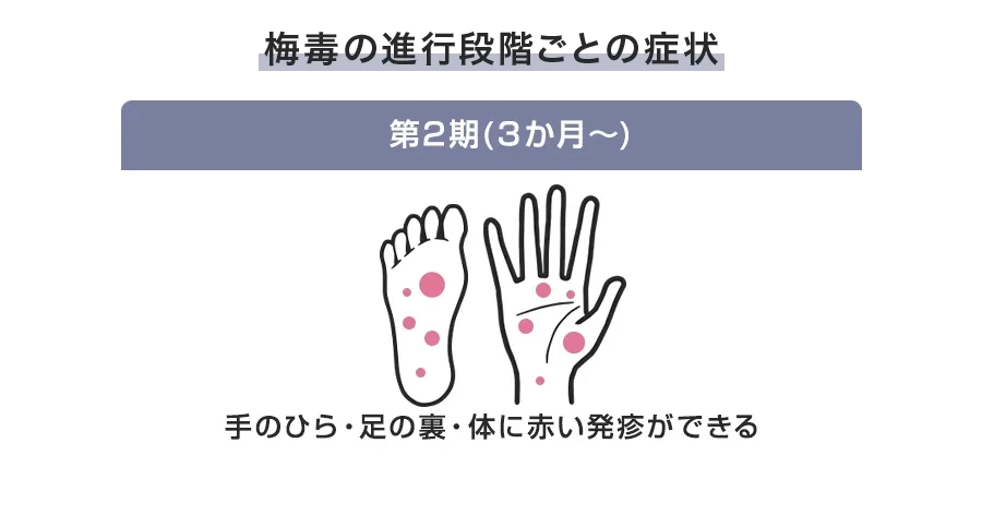 第2期梅毒の症状(全身症状・皮疹の特徴)