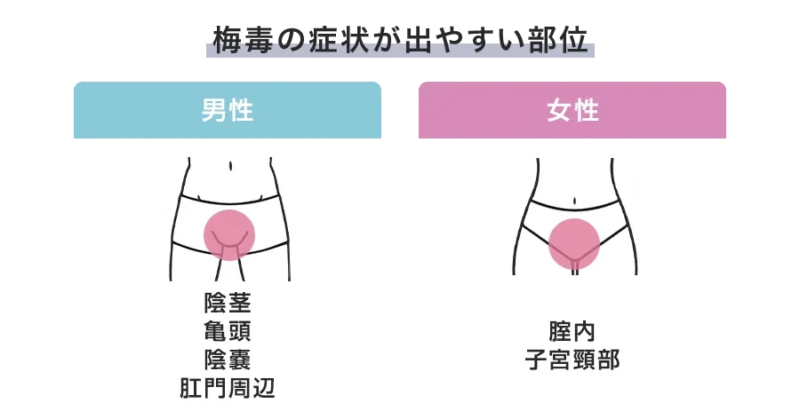 梅毒の症状は男女で違う?男性・女性それぞれの特徴