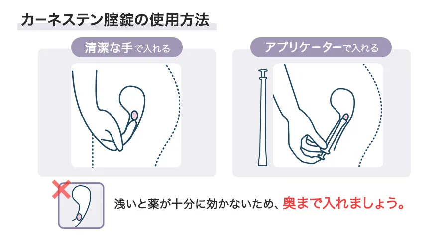 カーネステン腟錠の使用方法