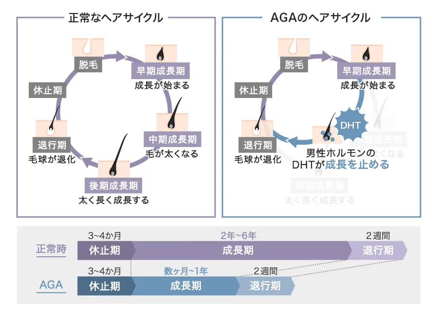 正常なヘアサイクルとAGAのヘアサイクル