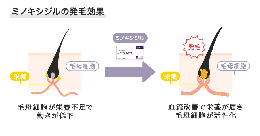 ミノキライズの発毛効果