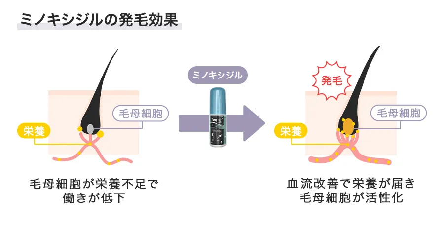 ミノキシジルの発毛効果