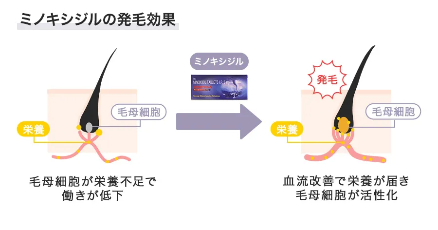 ミノキシジルの発毛効果